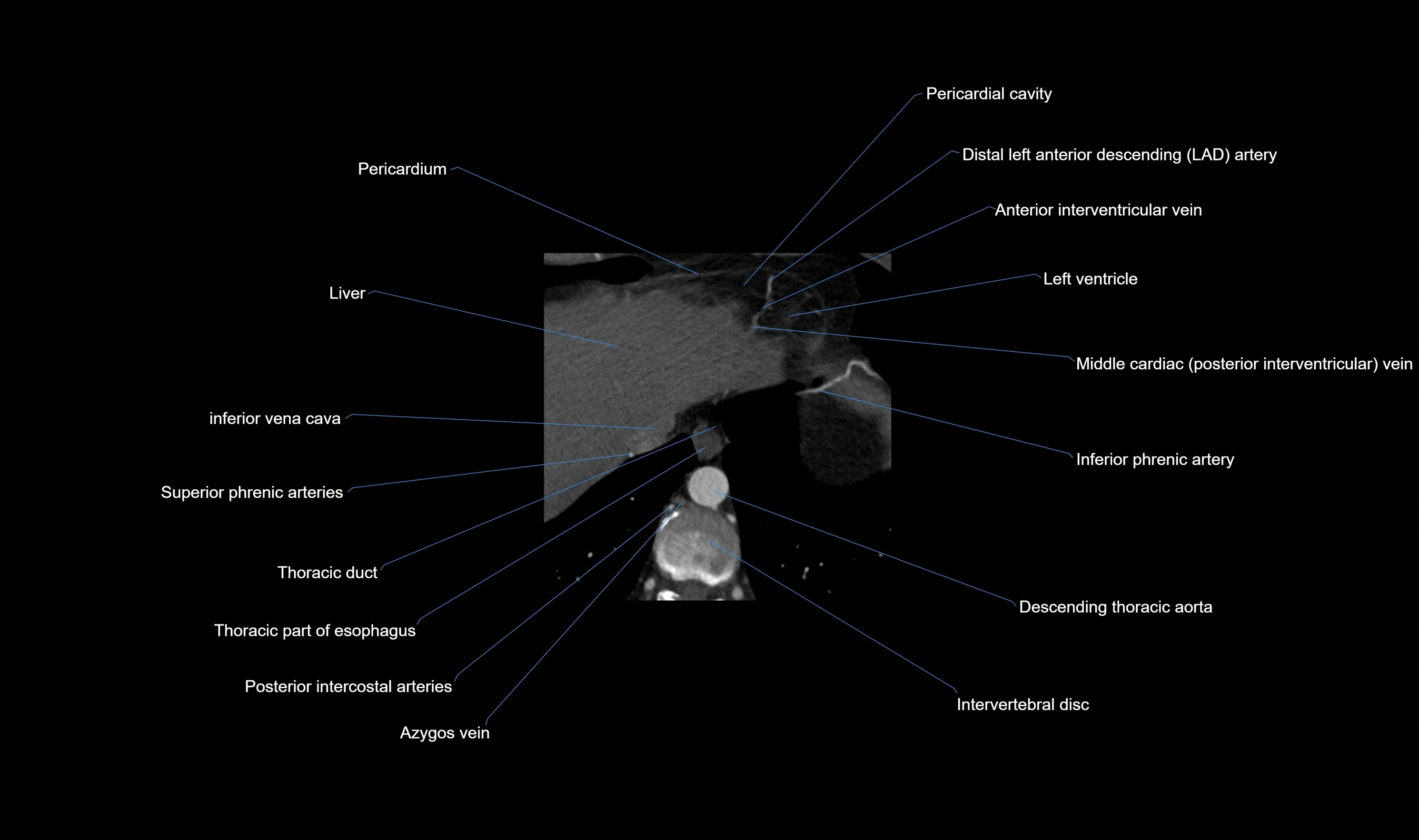 CT heart (coronary angiogram) axial view cross sectional anatomy labelled radiology image-00066.webp
